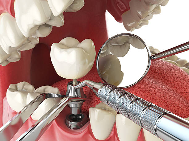 Best Emergency Root Canal Treatment in Port Morris, NJ