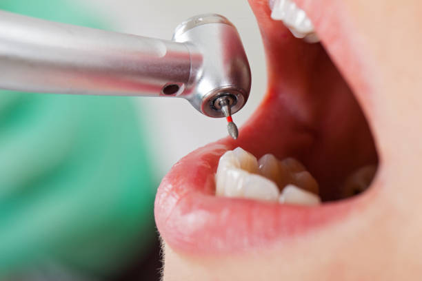 Best Emergency Dental Care for Broken or Chipped Teeth in Port Morris, NJ